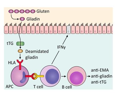 Diagram of celiac disease mechanism: gluten, gliadin, tTG, HLA, T cell, B cell, antibodies