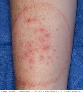 Ringworm infection on human skin