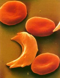 Sickle-cell anemia red blood cells