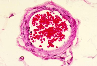 Blood clot with RBCs, platelets, and fibrin