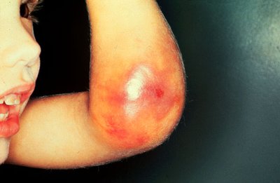 Hemophilia bruising