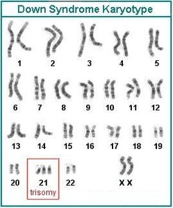 Down syndrome karyotype showing trisomy 21