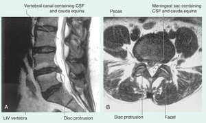 Intervertebral disk and herniation