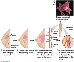 Growth and metastasis of a malignant breast tumor