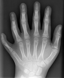 X-ray of polydactyly hand
