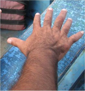 Hand with polydactyly