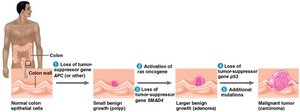 Multistep model of colorectal cancer development