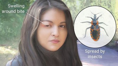 Chagas disease transmission and symptoms