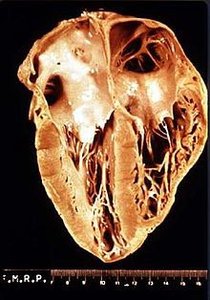 Heart damage from chronic Chagas disease