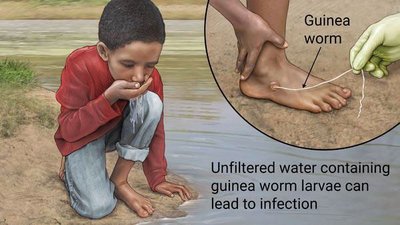 Guinea worm transmission via unfiltered water