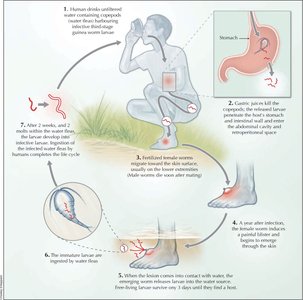 Life cycle of Guinea worm