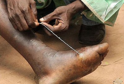 Manual removal of Guinea worm from foot