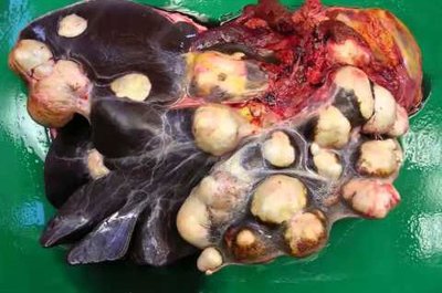 Cysts in the liver due to echinococcosis
