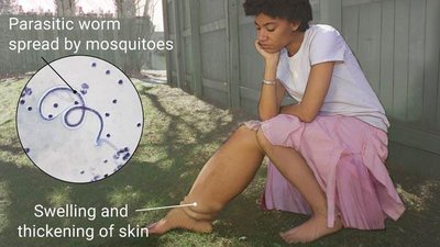 Lymphatic filariasis: swelling and thickening of skin