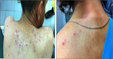 Clinical images of pediculosis (lice infestation)