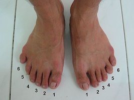 Polydactyly (extra digits)