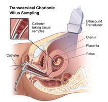 Chorionic villus sampling procedure
