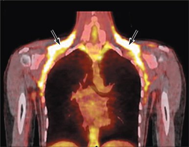 PET scan showing brown fat deposits in a human
