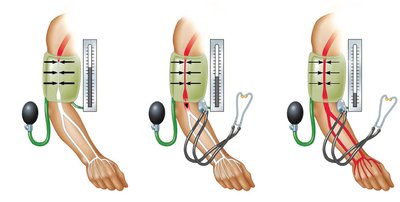 Measuring blood pressure with a sphygmomanometer