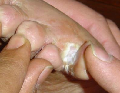 Athlete's foot infection