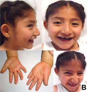 Individual with Angelman syndrome