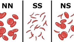 Sickle cell disease genotypes
