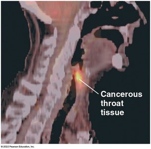 PET scan showing cancerous throat tissue
