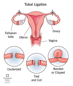 Tubal ligation procedure