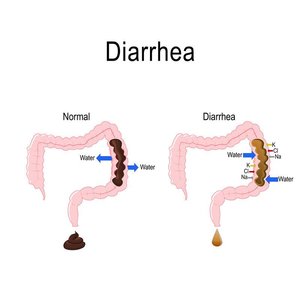 Normal vs. diarrhea water absorption in the colon