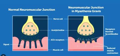 Normal vs. Myasthenia Gravis neuromuscular junction