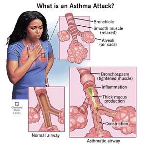 Asthma attack and airway constriction