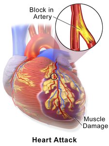 Heart attack showing blocked artery and muscle damage