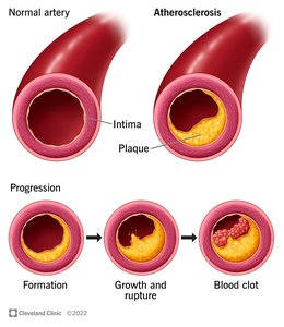 Atherosclerosis progression in arteries