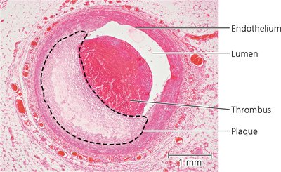 Histological section of an artery with a thrombus and plaque
