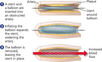 Diagram of stent insertion to treat an obstructed artery