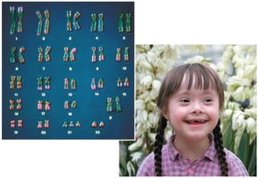 Karyotype and individual with Down syndrome