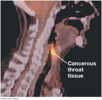 PET scan showing cancerous tissue