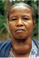 Goiter caused by iodine deficiency