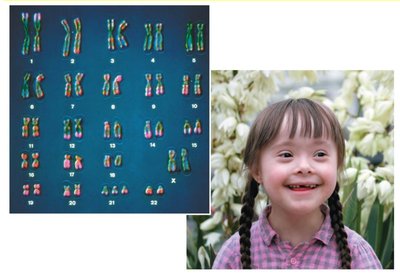 Down syndrome karyotype and phenotype
