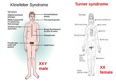 Klinefelter and Turner syndrome
