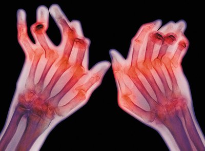 X-ray of hands deformed by rheumatoid arthritis