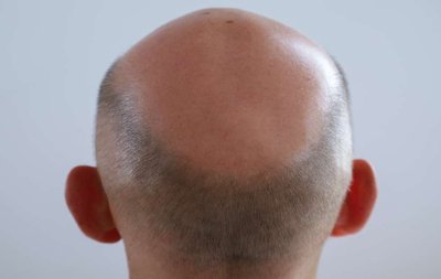 Pattern baldness as a sex-influenced trait