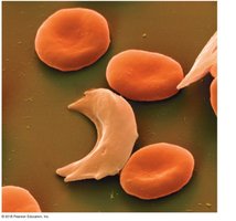 Sickle-shaped red blood cells