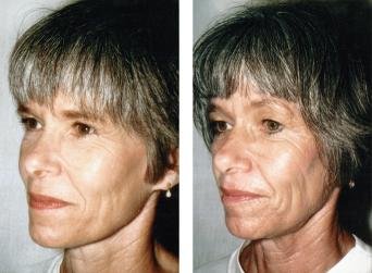 Diagram of twin study design