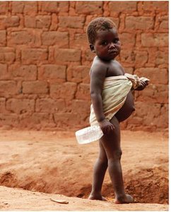 Child with signs of malnutrition