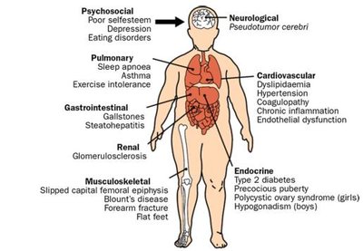 Diagram showing health effects of childhood obesity