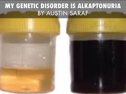 Urine samples showing alkaptonuria, a genetic disorder