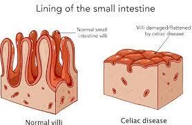 Infographic showing celiac disease risk modifiers: genes, family history, other autoimmune diseases