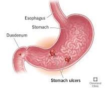 Diagram showing stomach ulcers in the stomach lining