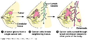 Metastasis of cancer cells